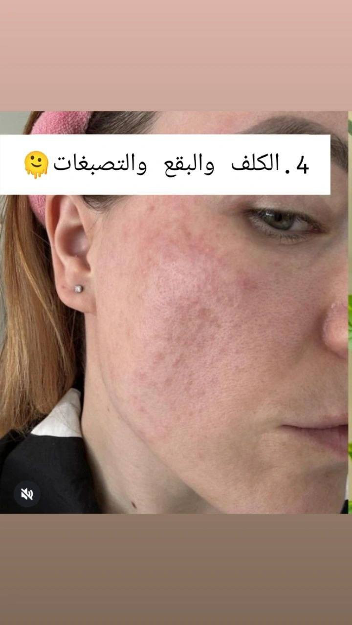 الحل الامثل للتصبغات والبقع الداكنه
عرض سيروم انوا النياسنمايد + ACM
#الاصلي_100 #منتجات_كورية #متابعة #اكسبلور #فولو


**إذا كنت صاحب هذا الإعلان وتريد حذفه لأي سبب، رجاءا أرسل رسالة إلى الدعم الفني**