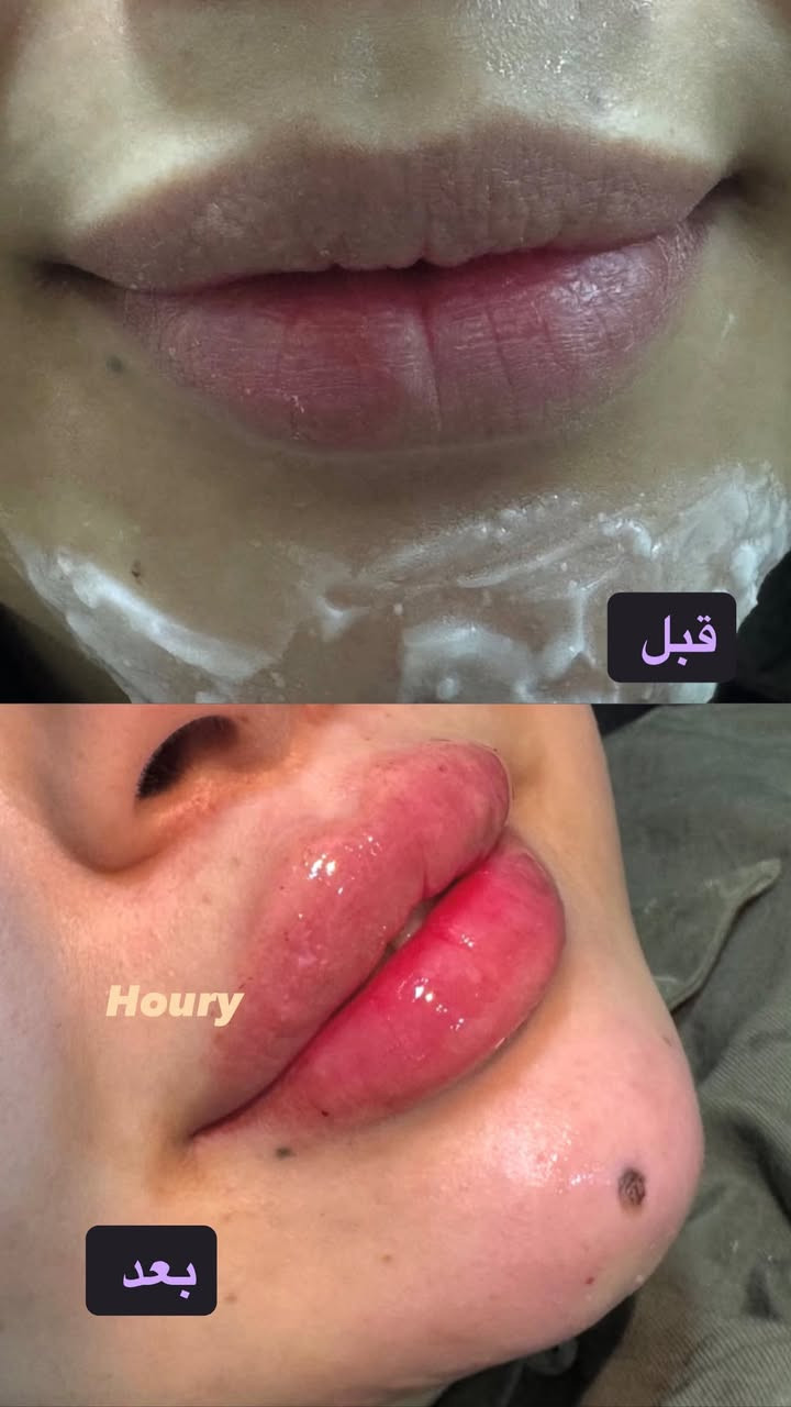 حقن فلر كوري
شفايف👄

1 سيسي 30الف

2 سيسي خصم 50 الف

وجه كامل🧏🏻‍♀️

10 سيسي 200الف

الشد المائي +نظاره +توريد 200 الف

عنواني السكلات منطقه 13

الصور كدامكم واي استفسار اني بالخدمه

*********** واتساب✅📞
