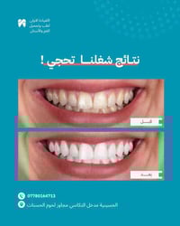 تبييض أسنان • أول جلسة • الحسينية مدخل التكاسي