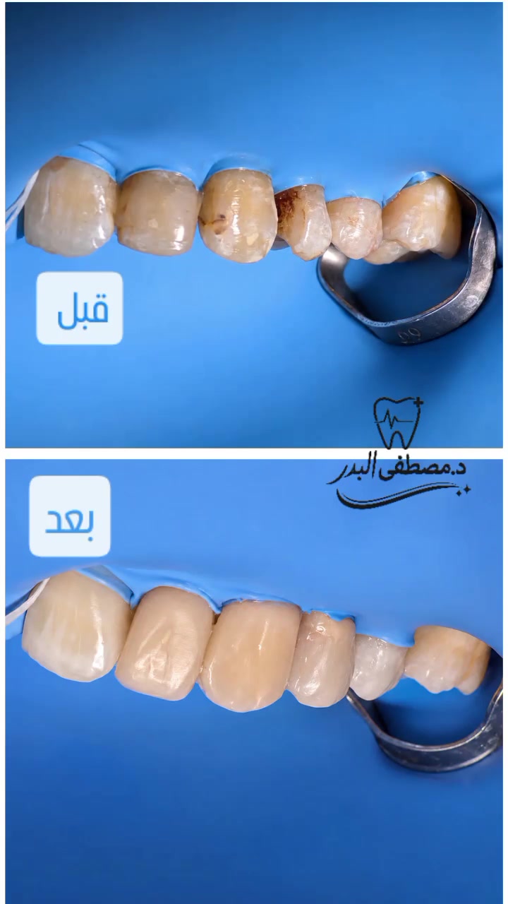 فرق التفاصيل يبين بالابتسامة
حشوات تجميلية رجعت شكل الأسنان الطبيعي بشكل مرتب وناعم 🤍🦷

✨نستقبلكم يوميا داخل عيادة البدر من ال3الى 8 مساءا والجمعة من ال9 صباحا الى 8 مساءا
✨العنوان الديوانية قضاء البدير مجمع وصيدلية دكتورة دعاء شاكر البديري 

للحجز والاستفسار الاتصال على 
***********

#حشوات_تجميلية
#تجميل_الأسنان
#حشوات
#ابتسامة
#اكسبلور_explore
