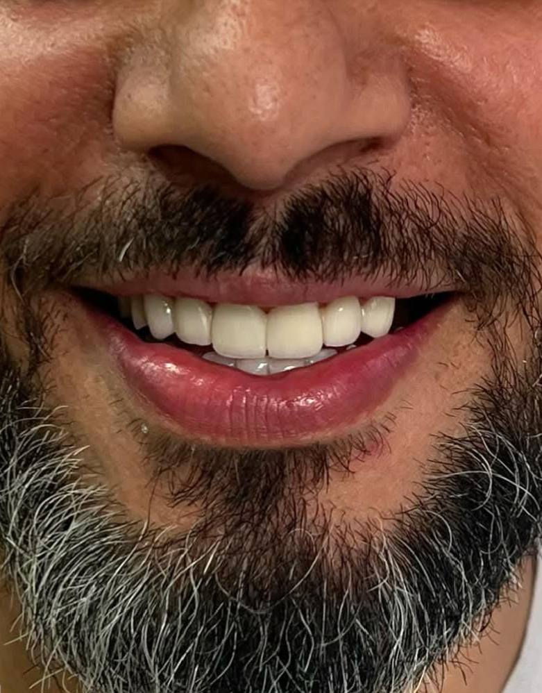 ابتسامة  ساحره وثقة مضاعفه 🩵🔥 عيادتنا فرع حي النصر 🔥🔥

تعويض الاسنان باستخدام (جسر زاركون ألماني) لمراجعنا  من بغداد الجديدة 
وتم تعويضها ب اسنان 
- الزاركون  الدائمي( الألماني) 
على يد الطبيب الاختصاص
د.محمد منصور 
(ماجستير في طب ومعالجة الاسنان) 

أبتسامتك ~ يم عيادات الفرح لطب وتجميل الأسنان ~ غير ✨😍

علماً كافة الابتسامات والحشوات مع ضمان مدى الحياة 😎

للإتصال 📞📞 
فرع حي النصر

*********** ☎️

دوام العياده ⏰
فرع حي النصر 
من الساعه 5  عصرا 
إلى 
الساعه 10 مساءا
