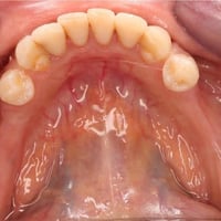 الي اسنانه هيج ويريد طقم اسنان متحرك خلي يراسلني ع خاص ( الطقم مجاني )...