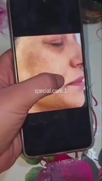 إزالة التصبغات • تفتيح دائم • معالجة البشرة