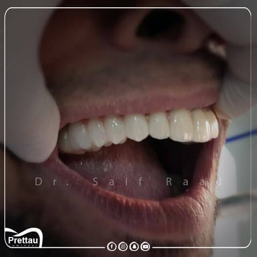 ✨ تريد ابتسامة هوليود ثابتة وبخصم 30%؟

هسه فرصتك حتى تحصل على ابتسامة ناعمة، مرتّبة، وتغليف زاركون ألماني مع تكنيك 7D اللي يطي شفافية وتفاصيل طبيعية تخبّل 😍

✔️ تغليفات ألمانية ثابتة
✔️ ضمان التركيبات 

💬✨مع عياده الرواسي لطب وتجميل الاسنان 
ابْتِسَاَمَتِگِ يمنااا غيررر

🧑‍🔬الدكتور سيف رعد /خبره اكثر م̷ـــِْن عشر سنوات في مجال طب وتجميل الاسنان 

📍 الحريه – الدولعي – داخل سوق الدولعي – ثاني فرع ع اليمين 
📞 ***********
