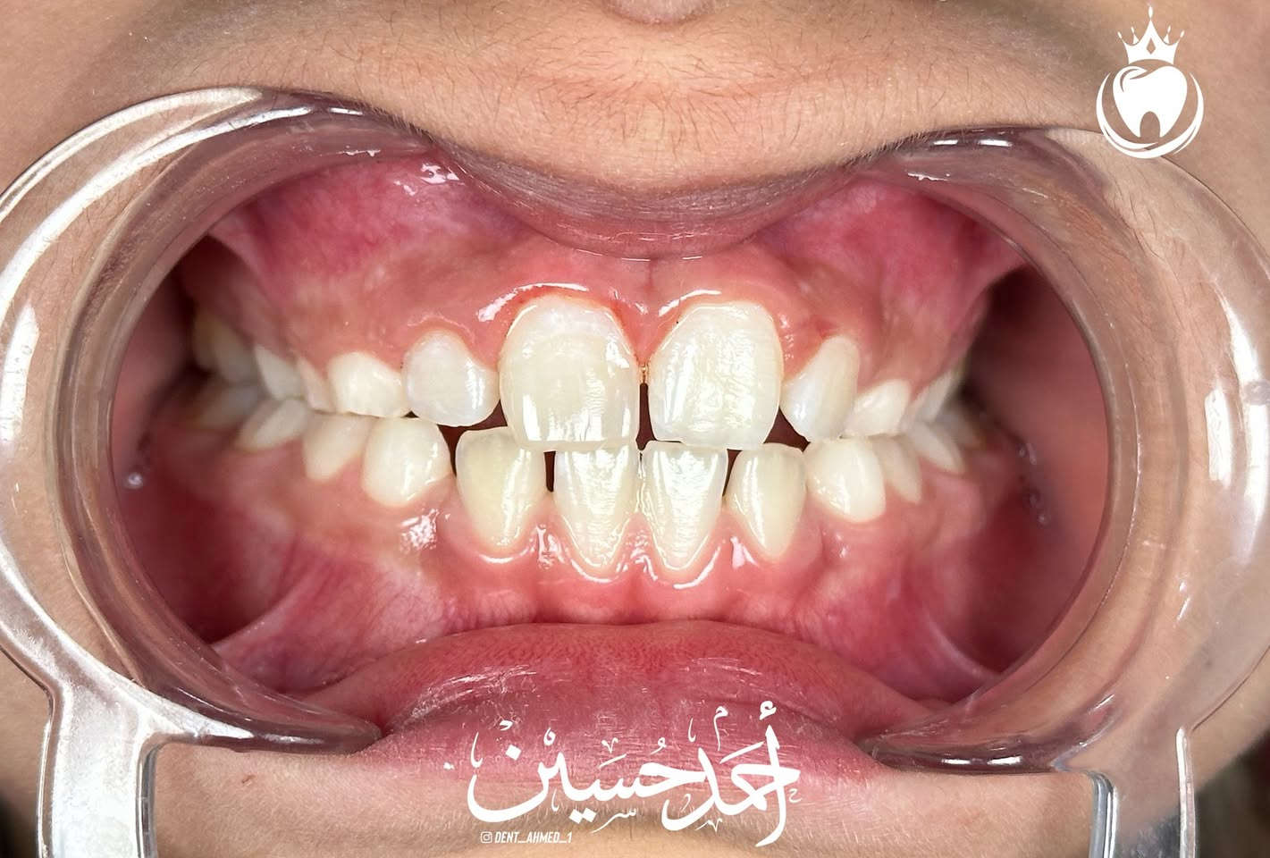 زارتنا طفلة مكسور سنها بسبب الوقوع🤕
 و هذا النوع من الحالات شائع بين  الاطفال في هذا العمر 
رجعنا السن لطبيعته بالحشوات و رجعنا ابتسامتها الحلوة بافضل المواد 
الشرح اسفل الصور 
المجمع الطبي الحديث مجاور مرطبات كرزة 
اوقات التواجد من ٣:٣٠ الى ٥:٣٠ قبل الافطار و كذلك بعد التراويح من ساعة ٩ الى ١٠:٣٠
للحجز و الاستفسار : ***********
