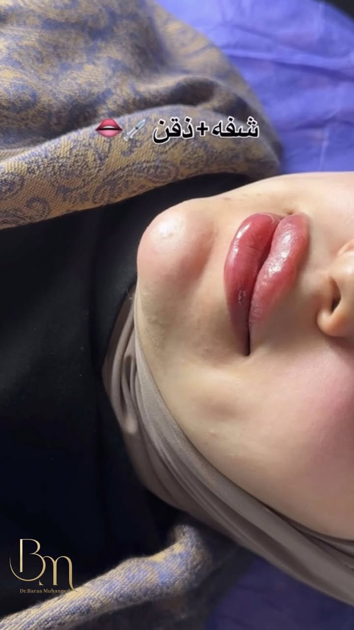 عيادة التجميل الاولى في الحسينية وتحت إشراف أطباء مختصين وبأنسب أسعار عنوان العيادة الجريخي مجمع الصدرين الطبي الطابق الثاني مقابل مطعم جكن اوسلو 
عيادة اوليفيا للتجميل 
للحجز والاستفسار واتساب ***********
