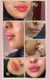 بوتوكس • فلر • تجميل • جمال • عيادة تجميل • الاء الشاوي • حقن الذقن • ...