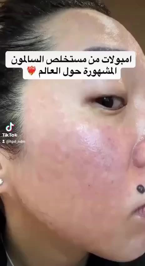 ⁨ ✨ أمبولات توهج وشد البشرة من مستخلص السالمون ✨
PDRN امبولات ميديكوب الوردية الكورية 
استمتعوا بتجربة فريدة مع مستخلص سمك السالمون، واكتشفوا إشراق بشرتكم! 💧

✅ تزيد الرطوبة بنسبة 58.7%
✅ تحسن التوهج بنسبة 38.8%
✅ مناسب للبشرة الحساسة وتم اختباره ضد الحساسية 

مع 99% من مستخلص السلمون، يسهل امتصاصه بدون لزوجة، ويعطيكم لمسة نهائية ممتلئة ومشرقة! 🌟
المنشأ كوريا الأصلي 🇰🇷🇰🇷🇰🇷


**إذا كنت صاحب هذا الإعلان وتريد حذفه لأي سبب، رجاءا أرسل رسالة إلى الدعم الفني**