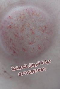 حجامة • دهون متراكمة • المقدادية