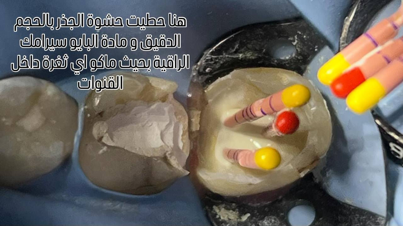 خطوات حشوت الجذر داخل العيادة  
صحة اسنانك ويا عيادة بيانو غير 🥰
 
المكان/ حي 17 الشارع العام لمكتبة المهندس مجاور لمدرسة المشاعل

 للحجز والاستفسار/ ***********
