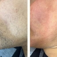 ليزر كانديلا • إزالة شعر • النعمانية