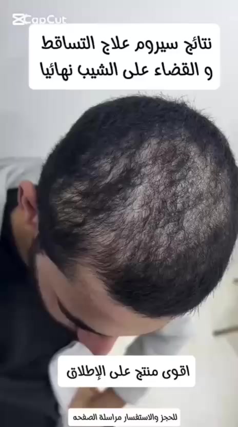 زيت الاعشاب لحل  (الشيب وتسويد الشعر ) رجال ونساء بالاعشاب الطبيعيةنتائج خلال 10 ايام فقط  نتائج دائمية خلطة اعشاب طبيعية فعالة علاج وليس صبغ او طلاء تعيد للشعر صبغته الطبيعية  خالي من المواد الكيميائية ودون اي تاثيرات جانبية تم طرح المنتج بعد تجارب فعاله


**إذا كنت صاحب هذا الإعلان وتريد حذفه لأي سبب، رجاءا أرسل رسالة إلى الدعم الفني**