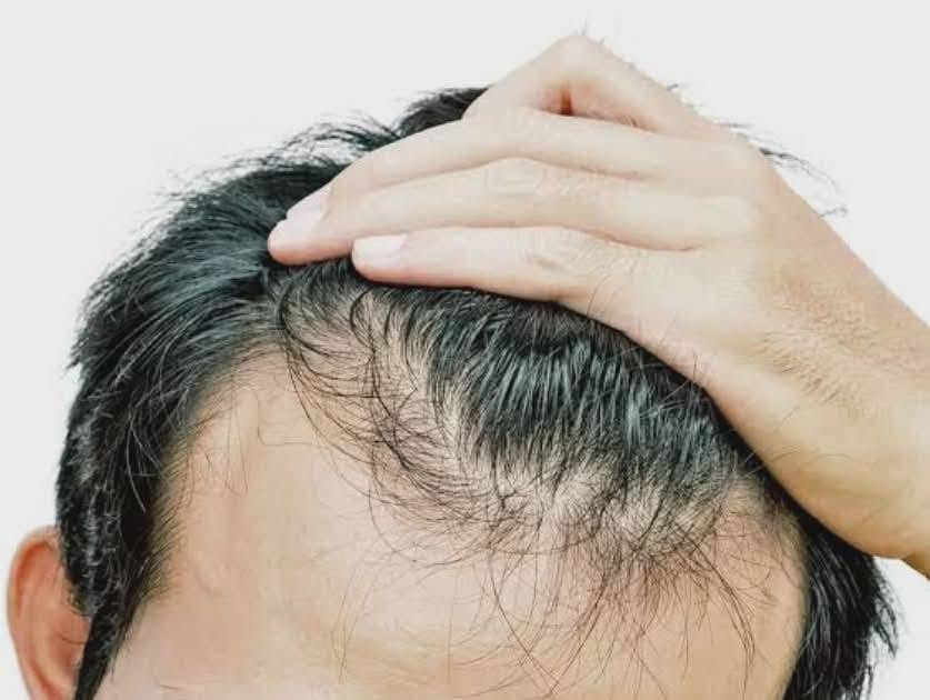 🌿 الحل المتكامل لشعر قوي ولحية كثيفة.. في بار واحد! 🧔🏻‍♀️🧔🏻
​هل تعبت من مشاكل تساقط الشعر، الفراغات، أو ضعف نمو اللحية؟ حان الوقت للتخلي عن المنتجات الكيميائية العشوائية واعتماد العلاج الطبيعي المكثف مع الشامبو بار (Shampoo Bar) العلاجي.
​هذا البار ليس مجرد منظف، بل هو تركيبة مركزة ومدروسة غنية بالزيوت العلاجية والأعشاب الطبية التي تستهدف بصيلات الشعر مباشرة لتمنحك نتائج ملحوظة للشعر واللحية على حد سواء.
​✨ الفوائد العلاجية الخارقة (للشعر واللحية):
​🚫 إيقاف التساقط من الجذور: يعمل على تقوية البصيلات الضعيفة وتثبيتها، مما يقلل التساقط بشكل ملحوظ منذ الأسابيع الأولى.
​🌱 تحفيز نمو شعر جديد (إنبات الفراغات): ينشط الدورة الدموية في فروة الرأس ومنطقة اللحية، مما يساعد على ملء الفراغات وظهور شعر جديد وصحي.
​💪 تكثيف وتقوية الشعرة: يغذي ألياف الشعر والفراغات بالفيتامينات الأساسية، مما يزيد من سمك الشعرة وكثافة المظهر العام.
​🛡️ علاج مشاكل الفروة والجلد: يقضي على القشرة، الحكة، والالتهابات التي تعيق نمو الشعر، ويوازن إفراز الدهون الطبيعية.
​✨ نعومة ولمعان طبيعي: يعيد الحيوية للشعر الباهت والتالف وللشعر الخشن في اللحية، ليجعلها أكثر ترتيباً وسهولة في التصفيف.
​🧪 لماذا يتميز الشامبو بار العلاجي الخاص بنا؟
​💡 تركيبة طبيعية مركزة: على عكس الشامبو السائل الذي يتكون من 80% من الماء والمواد الكيميائية، الشامبو بار الخاص بنا عبارة عن خلاصة صافية من المواد الفعالة والزيوت الطبية، خالي تماماً من السلفات والبارابين لضمان أمان تام وفائدة قصوى.
​📝 طريقة الاستخدام الفعالة:
​بلل الشعر أو اللحية بالماء الدافئ.
​دلك البار مباشرة للحصول على رغوة غنية وكثيفة.
​مهم جداً: اترك الرغوة تعمل وتتغلغل لمدة 2 إلى 3 دقائق لامتصاص المكونات العلاجية قبل الشطف.
​📥 لأن شعرك ولحيتك يستحقان الأفضل.. اطلب منتجك الآن!
تواصل معنا عبر رسائل الصفحة أو اتصل بنا مباشرة على الرقم: 0655931557 📞
​#عناية_بالشعر #عناية_باللحية #إنبات_الشعر #منع_التساقط #شامبو_علاجي #طبيعي_100


**إذا كنت صاحب هذا الإعلان وتريد حذفه لأي سبب، رجاءا أرسل رسالة إلى الدعم الفني**