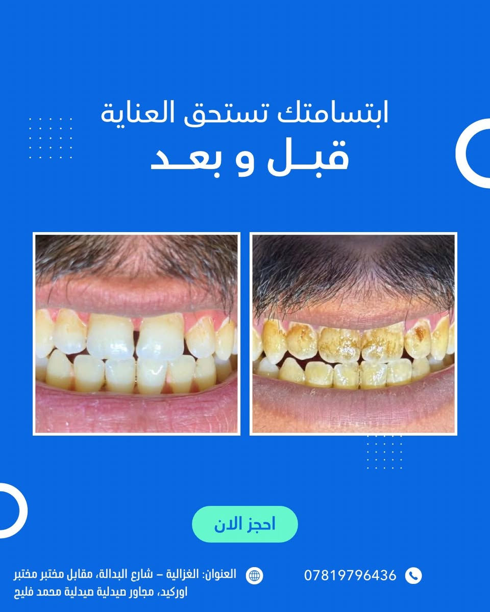 بشرى سارة 🌿

إلى أهالي الغزالية الكرام:

يسرّنا إعلامكم بـ اعلان عروض عيد الفطر المبارك في عيادة طب الأسنان التخصصية د.رسل رعد
 ونعلن عن تخفيض خاص بنسبة 50% ولمدة محدودة يشمل جميع الإجراءات العلاجية:

🔹 الحشوات التجميلية
🔹 حشوات الجذور
🔹 قلع الأسنان الاعتيادي والجراحي
🔹 تقويم الأسنان
🔹 زراعة الأسنان
🔹 تبييض وتنظيف الأسنان

✨ الفحص مجاني

💚تتوفر خدمة العلاج بالأقساط

📍 العنوان: الغزالية – شارع البدالة، مقابل مختبر مختبر اوركيد، مجاور صيدلية صيدلية محمد فليح
📞 هاتف العيادة: ***********
 0780 705 4413
🕓 أوقات الدوام في شهر رمضان المبارك بعد الافطار: من الساعة 7:00 مساءً ولغاية 11:00 مساءً

أهلاً وسهلاً بكم 🌸
صحتكم تهمّنا دائمًا
