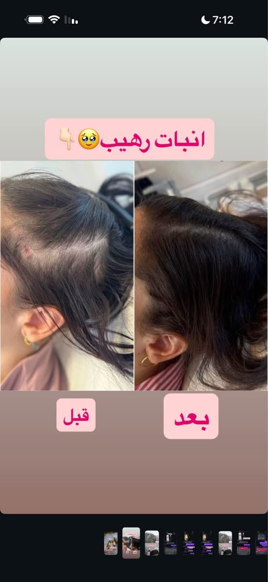 معالجه تساقط الشعر 
يخلصكم من تقصف الشعر 
امن على الفروه الراس مابي اي اضرار 
ينطي ترطيب للشعر 
من اول اسبوع يبين الفرق
السعر 15الف شامل توصيل 
لحجز تواصل واتساب 
*********** بغداد, العراق
