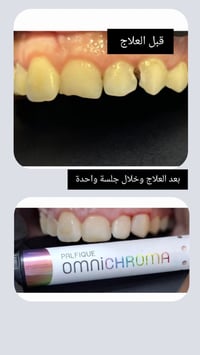 علاجات اسنان • تسوس امامي • جلسة واحدة