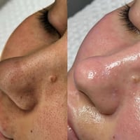 هايدروفيشل • تنظيف البشرة • عيادة سنايا