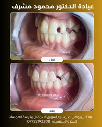 حشوة تجميلية أعادت للسن شكله الطبيعي ووظيفته ✨🦷  التسوس أو الكسر البسي...