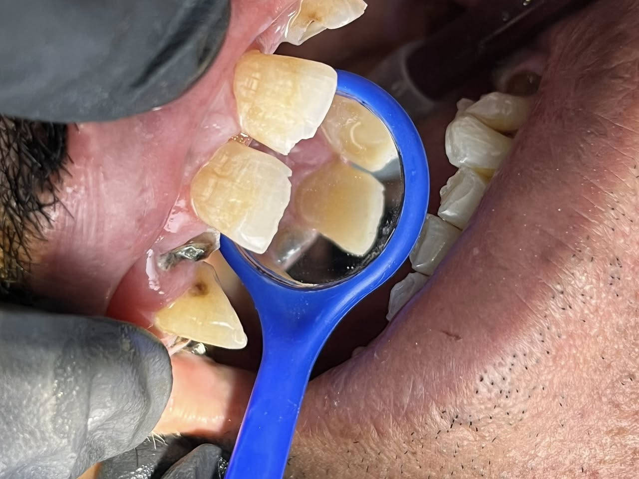 باجر متواجده بالعياده الي يريد يحجز مجاني لشغل اسنانه يخابرني واتساب *********** (#موقع العياده شارع الحولي يم قاعة المهندس للانتصارات ))
