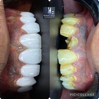 كشفية مجانية • تقسيط بدون مقدم • تبييض ليزر