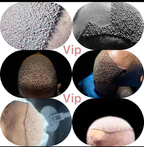 ملاحظة مهمّة جدًا 👇
قبل لا ينسرق الكلام من قبل المراكز
ويبدون يحچون بنفس الطريقة ونفس الصيغة

مركز المتخصص
هو المركز الوحيد
اللي يشرح كافة التفاصيل
قبل الزراعة وبعد الزراعة 🫵🔥👌

انتبه زين
قبل لا تتخذ القرار النهائي 👇

⸻

خطة زراعة الشعر مضمونة
على يد الطبيب المختص
شغل دقيق
يقلّل نسبة الخطأ إلى أدنى حد

المركز يتحمّل مسؤولية أي خطأ
أمّا نجاح العملية
فيعتمد على خبرة المختص
الذي يقوم بقطف البصيلات
بدقّة عالية جدًا

كما تعتمد النتيجة على
غرز البصيلات في المكان الصحيح
بعد فتح القنوات
بزاوية واتجاه صحيحين
وبما يتوافق مع اتجاه الشعر القديم

وتعتمد مرونة ومظهر الشعر
على عمق فتح القنوات
وبقياسات هندسية دقيقة
مدروسة بعناية
من قبل المختص

⸻

VIP اختيارك المفضّل

📞 واتساب للحجز:
***********

📞 الإدارة (واتساب):
***********

📞 واتساب للحجز:
***********
