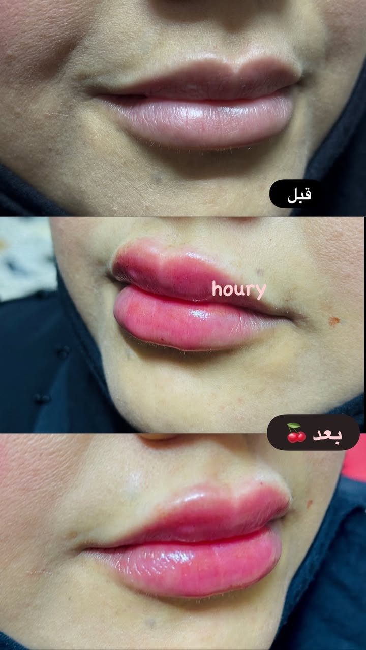 حقن فلر كوري
شفايف👄

1 سيسي 30الف

2 سيسي خصم 50 الف

وجه كامل🧏🏻‍♀️

10 سيسي 200الف

الشد المائي +نظاره +توريد 200 الف

عنواني السكلات منطقه 13

الصور كدامكم واي استفسار اني بالخدمه

*********** واتساب✅📞
