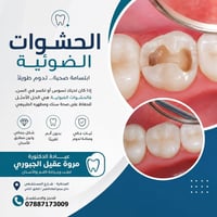 حشوات ضوئية • دكتورة مروة الجبوري • المناذرة