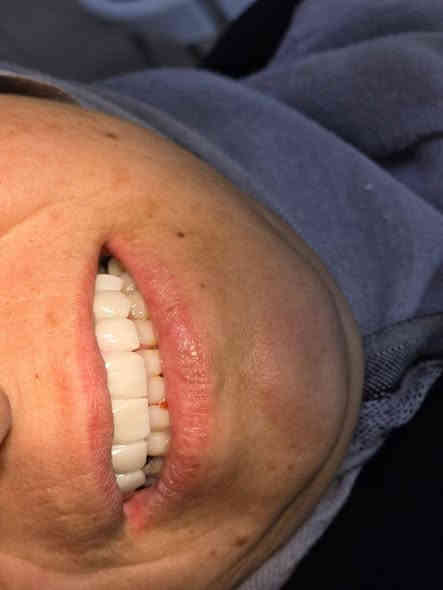 😁اليوم الحاله هي تغيير جذري لابتسامة مراجعتنا😁

💎تم عمل تركيب و تغليف زاركون درجة اولى اصلي لمراجعه تعاني من فقدان اسنان اماميه و ايضا كسر في الاسنان الاخرى 

💢تم برد الاسنان الاماميه بقياسات علمية دقيقة 
💢تم عمل الحشوات بواسطة العازل المطاطي قبل تحضير الاسنان 
💢اخذ طبعة بواسطة الصورة الرقميه للاسنان و تمتاز هذه المادة بدقة عالية لاخذ قالب الاسنان 
💢ارسال الطبعة الى مختبر ذو ايدي خبيرة و ماهرة في عملها 
💢ثم تركيب اسنان الزاركون للمراجع

✨كل هذا العمل بجلستين فقط !!
✨و النتيجه مثل ما تشوفون 
✨احلى شعور من تشوف المراجع فرحان بابتسامته من جديد

✨ابتسامتكم ويانه احلى✨
عيادة البدر لطب وزراعة وتقويم الاسنان 
للحجز والاستفسار:
***********
