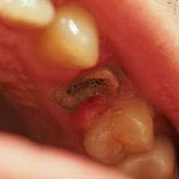 علاج أسنان • مجاني • كلية طب الأسنان