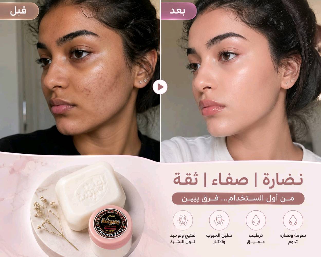 قسمًا بالله فرق واضح من أول استخدام وداعًا للحبوب ✨ الكلف ✨ التصبغات ✨  وشحوب البشرة -وكلشي مضر 
صابونة + دهن خبطة العناية من متجر بموشة ومنتجات الشاوي 💛
✅ تبييض ونضارة✅ توريد الوجه والمناطق الحساسة✅ شد البشرة وتقليل التجاعيد✅ ترطيب عميق ولمعة صحية✅ تخفيف آثار الحبوب والكلف✅ نتائج تلاحظها بنفسك
💯 مناسبة للبنات والشباب💯 مكونات آمنة ولطيفة على البشرة فرق من اول 3 ايام 
الك حق اترجعها اذا ماشتغلت بعد 7 ايام وتخابرنه وتدلل - اصلي فقط اصلي
📞 للحجز والاستفسار***********
الجمال يبدأ من العناية الصحيحة ✨ 
توضيح اكثر داخل الصور شوفو واقرو 👇 

#متجر_بمبوشة
#منتجات_الشاوي