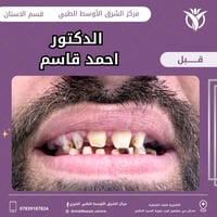 تركيب أسنان • دكتور احمد قاسم • مركز الشرق الاوسط