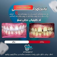هوليود سمايل • زيركون إيماكس • كالار