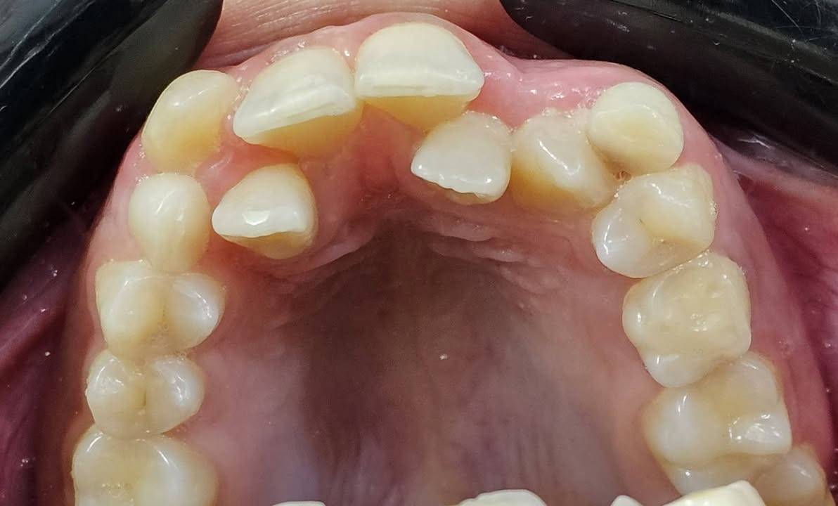 فاطمة اجتنة عدها اسنان لبنية وعدهة سن مطمور ضاحك وعدها الناب الدائمي صاير بالمقدمة وسنين اماميات راجعات ليورة خلال سنة وثلاث اشهر كدرنة نحل اغلب هاي المشاكل 

العنوان / المسيب / شارع البلدية / مقابل دكتور جعفر وفي للاطفال مجاور عالم الحليب

للحجز والاستفسار 
***********
***********
