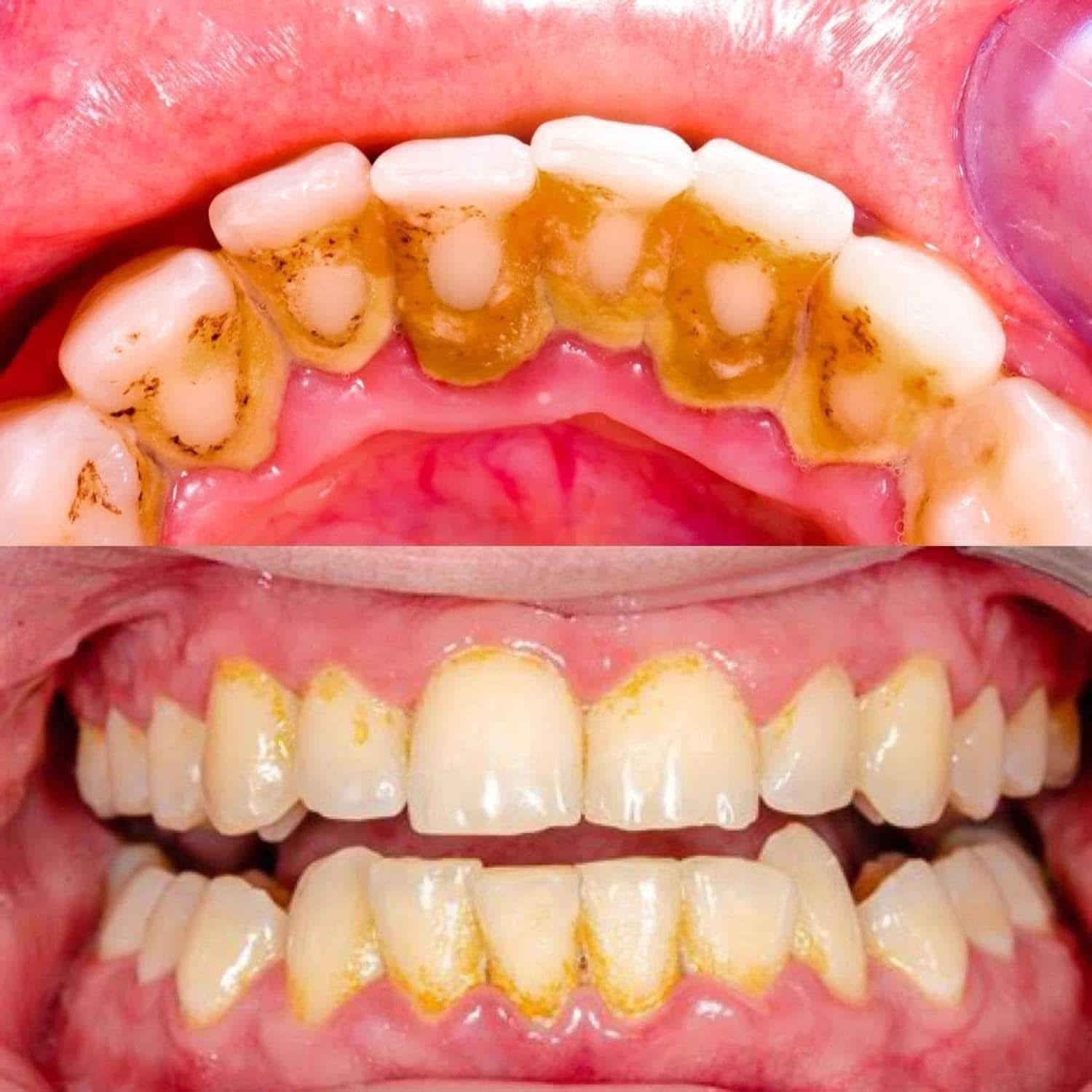 مجانا مجانا بالكامل
نقدم لكم الخدمات التالية بشكل مجاني بالكامل :

١- فحص شامل للفم والأسنان .
٢-تنظيف الأسنان وإزالة التكلسات والتصبغات .
٣- حشوات ضوئية وتجميلية .
٤- قلع الأسنان التالفة والجذور المتبقية .
٥- تعويض الأسنان المفقودة باطقم جزئية متحركة وكاملة. 

العنوان:الدورة الميكانيك نهاية شارع ٦٠ عيادات جامعة الهادي 
للحجز والاستفسار الاتصال او الواتساب ***********
