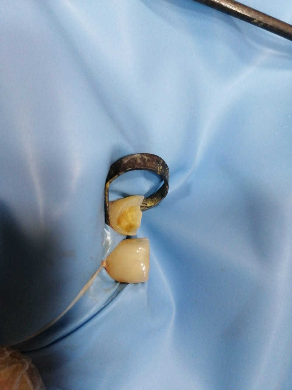 ترميم السن الأمامي المكسور ..
د مهند عبد الجواد الطحان الهاشمي
ماجستير ودبلوم عالي تعويض الأسنان.. سايدين مستشفى #القيارهالعام.. للحجز والاستفسار التواصل على الرقم ***********# مجاور صيدليه عبدالله المعماري.. طابق ارضى.
