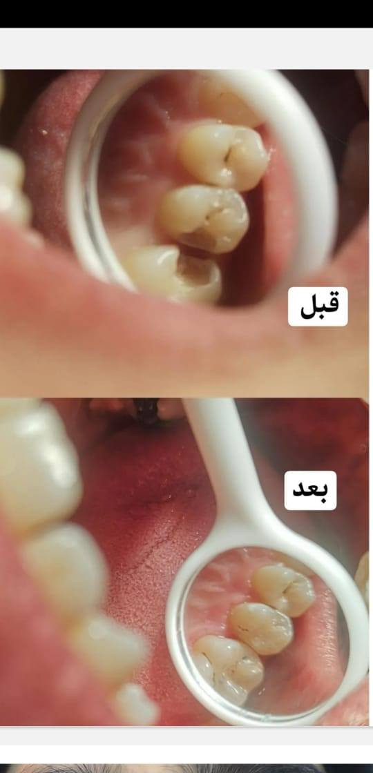 ✨ عروض مميزة على جميع خدمات طب الأسنان… ابتسامتك بأفضل سعر!
🦷 ابتسامة صحية بأسعار رمزية لا تفوت الفرصة!
💎 خصومات خاصة على تنظيف وتجميل الأسنان لفترة محدودة!
🌟 لأن ابتسامتك تهمنا… نقدم لك أفضل العروض بأعلى جودة!
🔥 عروض حصرية على علاجات الأسنان… احجز الآن وابتسم بثقة!

عيادة الارجوان لطب الاسنان/ سبع البور شارع الاربعتالاف 4000 ضمن مجمع دكتوره ديانا الزبيدي
واتساب ***********
