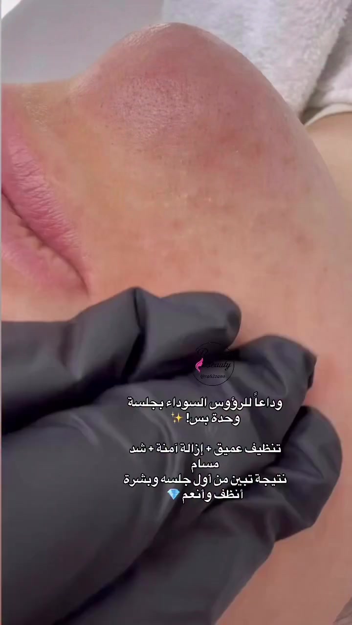 ❌ وداعاً للرؤوس السوداء… بجلسة وحدة وبنتيجة تبين من أول يوم!

تعبانة من المسام المفتوحة والرؤوس السوداء اللي ترجع بسرعة؟
يمنه الحل الآمن والاحترافي ✨

💎 جلسة تنظيف عميق ملكية تشمل:
✔️ تقشير خفيف يفتح المسام بلطف
✔️ إزالة الرؤوس السوداء بدون ألم مبالغ
✔️ جهاز الهايدروفيشل 7 مراحل
✔️ تعقيم وتهدئة البشرة
✔️ قناع شد مسام + ابره نضارة

✨ النتيجة: بشرة أنظف، أنعم، ومسام أصفى من أول جلسة
✨ بدون آثار أو تصبغات
✨ شغل نظيف وتعقيم كامل

📍 البياع ش12 تقاطع الحمام خلف مكتبه ميم
📞 ***********
