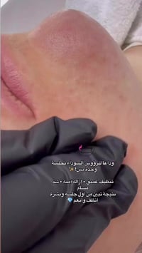 ❌ وداعاً للرؤوس السوداء… بجلسة وحدة وبنتيجة تبين من أول يوم!  تعبانة م...