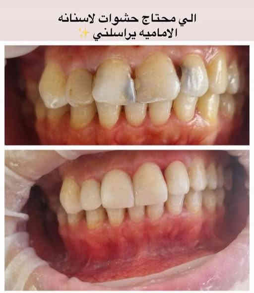 السلام عليكم 
اللي يحتاج علاج يخص اسنانة من حشوات وقلع وتنظيف وتعويض الاسنان المفقودة بطقم كامل او للاطفال قلع وتنظيف وحشوات ، يتواصل وياية احجزلة موعد بالمستشفى التعليمي لجامعة الكوفة 
للتواصل على حساب الفيس بوك 
او  واتس آب ***********
