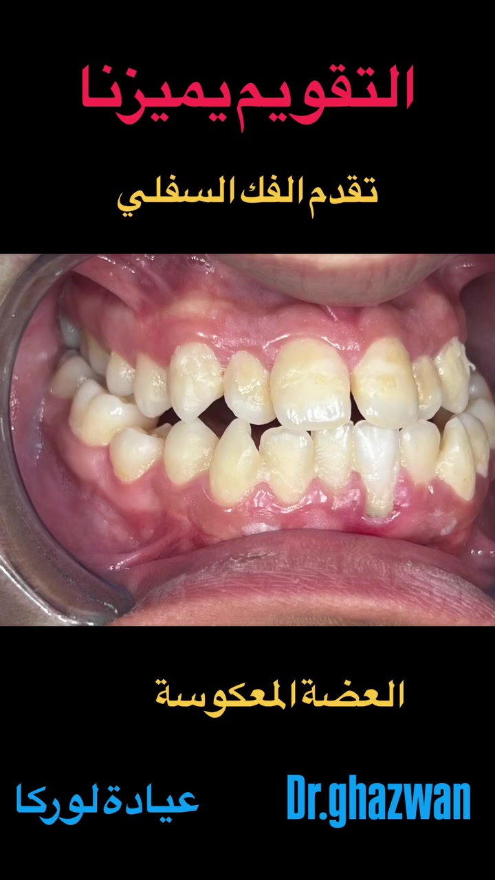 التقويم يميزنا احد حالات العضة المعكوسة تقدم الفك السفلي و تراجع العلوي …. يعاني من مظهر خارجي غير متناسق و عدم القدرة على تقطيع الطعام و الكلام و انزعاجات اثناء النوم و عدم القدرة على تنظيف الأسنان بشكل صحيح… علاج جميع الحالات الصعبة و المعقدة نتائج مضمونة طرق علمية متمكنة من جميع الحالات خبرة طبية طويلة اثناء ممارسة الكثير من الحالات جمالية فائقة الروعة للاسنان … دكتور غزوان مزهر بغداد الكرخ نفق الشرطة بداية شارع الاطباء عيادة لوركا فوق صيدلية كنز النفق متوفر واتس *********** #تقويم_الأسنان_والفكين #تقويمالأسنان #تقويم_الأسنان_بأنواعه #تقويم_الشفاف_للأسنان #تقويم_الأسنان_قبل_وبعد  @تقويم_الاسنان @تقدم_الفك_السفلي @العضة_المهكوسة
