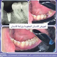 تعويض الاسنان المفقودة بزراعة الاسنان   يسعدنا استقبالكم يومياً عدا يو...