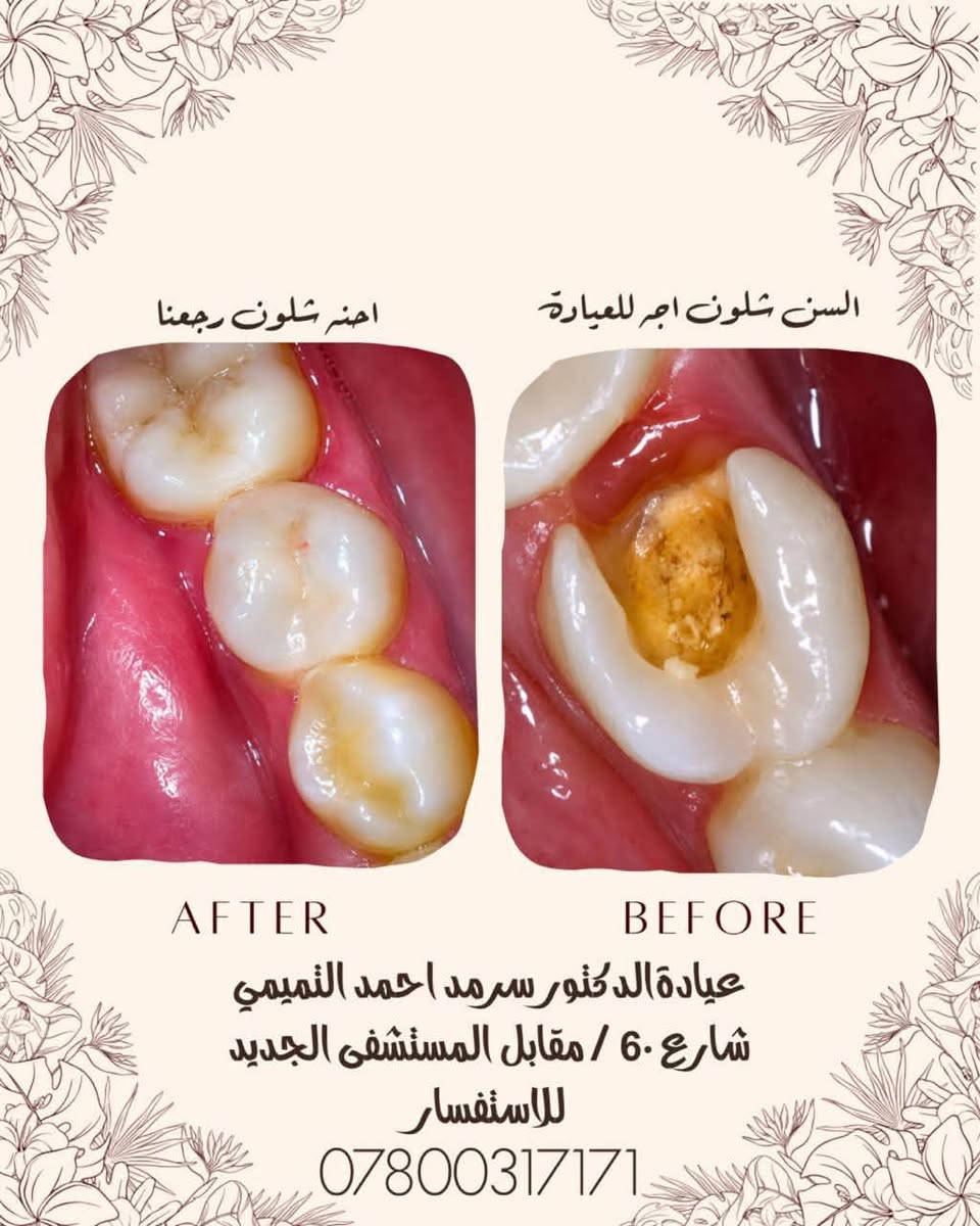 ✨ ابتسامتك تبدأ ويانه! ✨🦷
تعلن عيادة الدكتور سرمد احمد التميمي عن تقديم أفضل الخدمات العلاجية والتجميلية بأحدث الأجهزة حرصًا منا على راحتكم وصحة أسنانكم.

🔹 خدماتنا تشمل:
• تنظيف وتلميع الأسنان
• حشوات تجميلية وعلاج التسوس
• سحب العصب وعلاج الألم
• قلع الأسنان والجراحة
• تركيبات ثابتة ومتحركة
• تبييض الأسنان
• علاج لثة ونزف اللثة
• متابعة وعلاج أسنان الأطفال
وباسعار مناسبة 💙🦷✨

📍 العنوان: [ مجمع الشفاء شارع 60 مقابل المستشفى الجديدة ]
📞 للحجز والاستفسار: [ ***********]

🌟 لأن ابتسامتكم تهمنا… نهتم بأدق التفاصيل لنمنحكم الراحة والثقة.
زورونا وخلي ابتسامتكم تحچي عنكم
