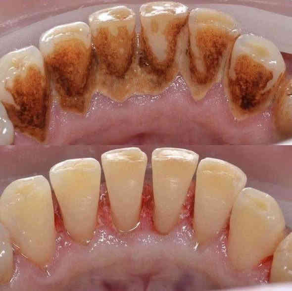 🔴مجاناً.. مجاناً.. مجاناً..
🔴نُعلن عن استقبال الحالات التالية مجاناً وباشراف دكاترة اختصاص:
✅ تنظيف وازالة تكلسات الاسنان + تبييض
✅قلع الاسنان والجذور التالفة 
✅حشوات ضوئية للاطفال
للحجز:  وتساب ***********
الموقع:  كربلاء الحر عيادات جامعة اهل البيت
