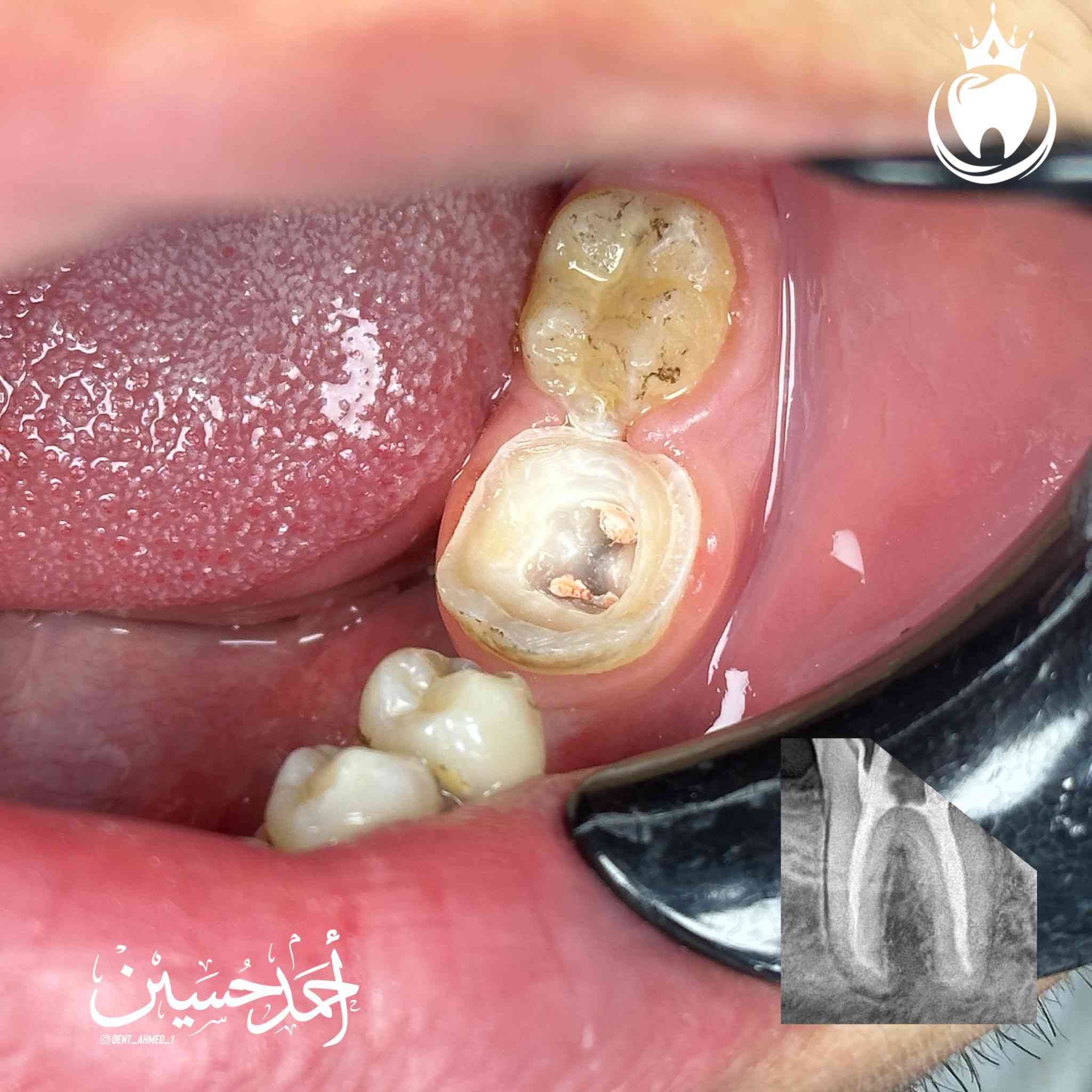 هذه الرحاة كان مصيرها القلع حسب قرار الطبيب السابق لكن قررنا نحافظ عليها كون الجزء المتبقي بعد ازالة التسوس يعتبر مناسب نوعا ما و رغبة المراجع في الحفاظ على هذا السن  و بناءََ على ذلك بدينا رحلتنا لأرجاعها الى وضعها الطبيعي😎
شرح الخطوات اسفل الصور 

الدكتور احمد حسين الطعماوي 
ناحية الزاب - المجمع الطبي الحديث مجاور مرطبات كرزة
الدوام طيلة ايام الاسبوع من الساعة ٣:٣٠ الى الساعة ٨:٠٠ مساءا
للحجز و الاستفسار : ***********
