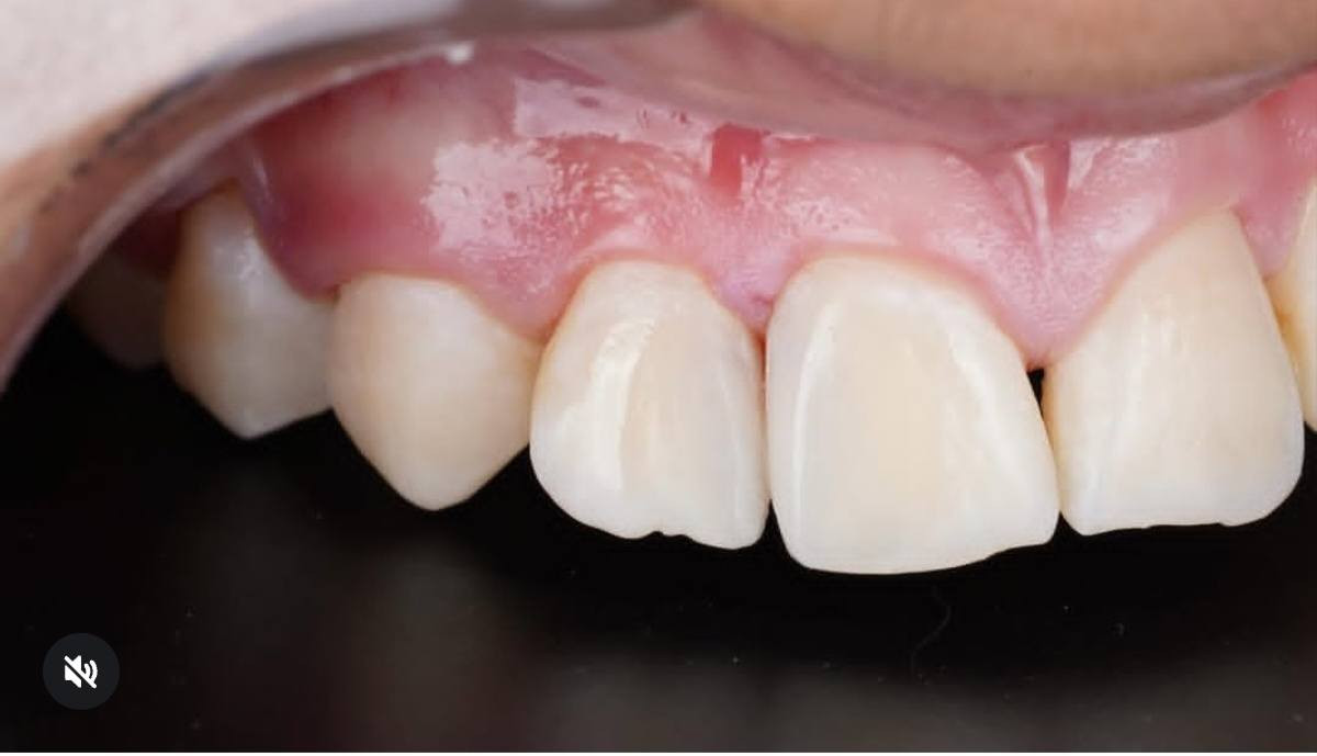 التسوس المخفي بين الاسنان😖
من التسوسات المزعجة للمراجعين
وخاصتاً اذا كان بالاسنان الضاحكة🦷🦷
تمت معالجته بحشوات تجميلية بنفس لون الاسنان البقية👌💫
عياده الرواسي الحل الافضل لمعالجه اسنانك بكل ثقه😍
الدكتور سيف رعد 🧑‍🔬🧑‍🔬
للحجز والاستفسار  /مراسله الصفحه
او الاتصال ع الرقم //***********
