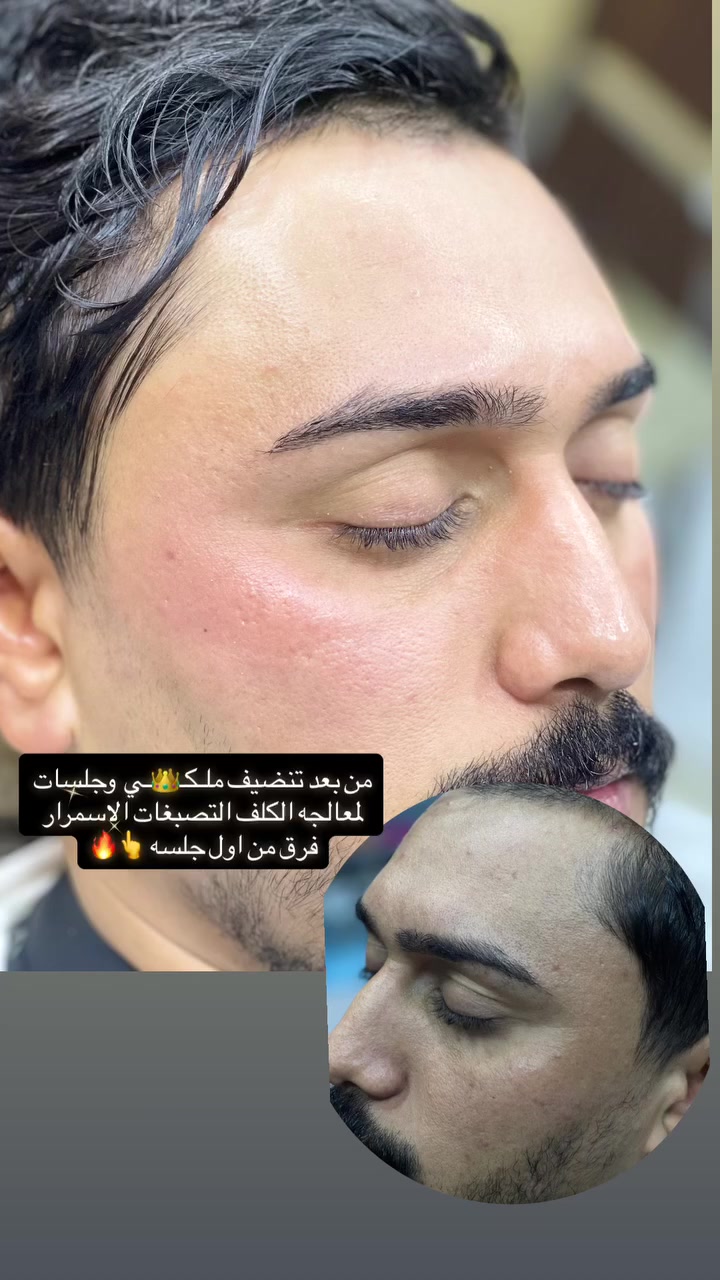 موافقه ادمن جزاك الله خير 🤍
بدت عروض العيـــد 🎉 والخصم لكل مايخص البشره من تنضيف هايدروفشل تنضيف ملــكــ👑ــي معالجه تجميل تغير شامل حقن ابره النضاره جلسات ديرمابن لمعالجه  البشره من العيوب الكلف التصبغات معا نضاره بياض  تصفيه كله متوفر يمي  كل مايخص جلسات وعمل المراكز متوفر بـ اسعار كلش مناسبه 

ام قصر شارع 8 ركن مقابيل موكب ابو هادي 
الماكيـــر حسيـــن. للتواصل. ***********
