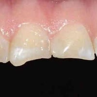 حشوات تجميلية • عيادات جامعة الكوت • معاينة مجانية