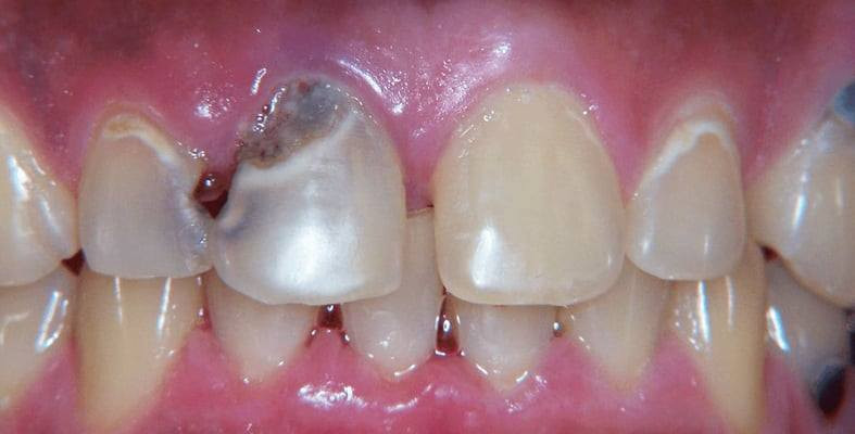 🦷💥 تسوس الأسنان؟ لا تقلق!
علاج التسوس سريع وآمن، لن تترك أي ألم أو حساسية خلفك!
✨ تنظيف كامل للأسنان
✨ حشوات آمنة وطويلة الأمد
✨ نصائح للوقاية من التسوس
احجز الآن وابتسم بثقة! 😁
📞 للحجز: ***********
***********
***********
📍 المكان: [بغداد/الكراده/شارع ٥٢/عيادات جامعة اوروك ]
