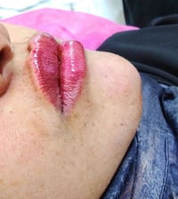 فيلر شفايف • عيادة المينا • شارع الأطباء