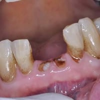 قلع اسنان • حشوات ضوئية • علاج مجاني